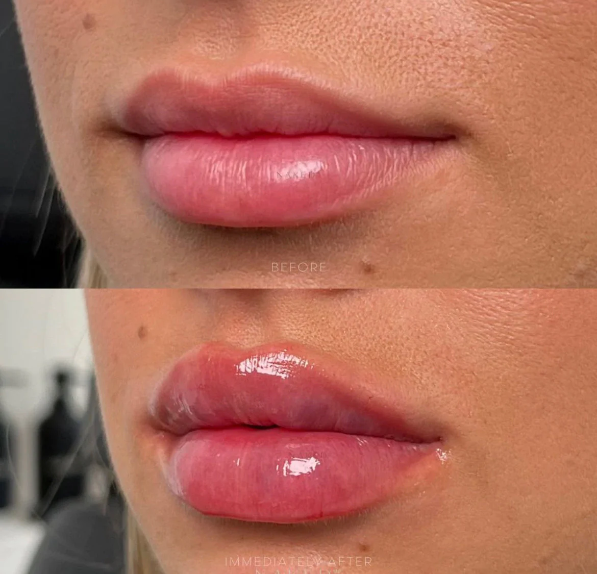 Lip Filler | New Client Offer - Image 69