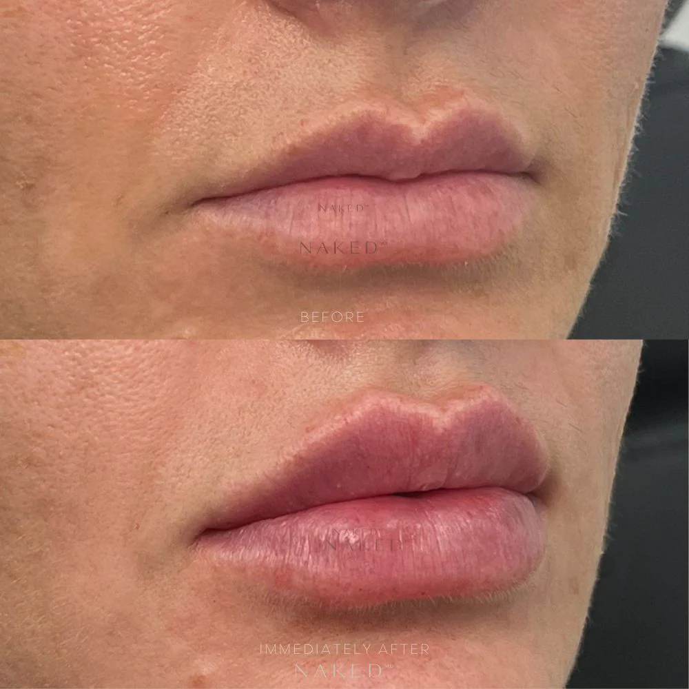 Lip Filler | New Client Offer - Image 7
