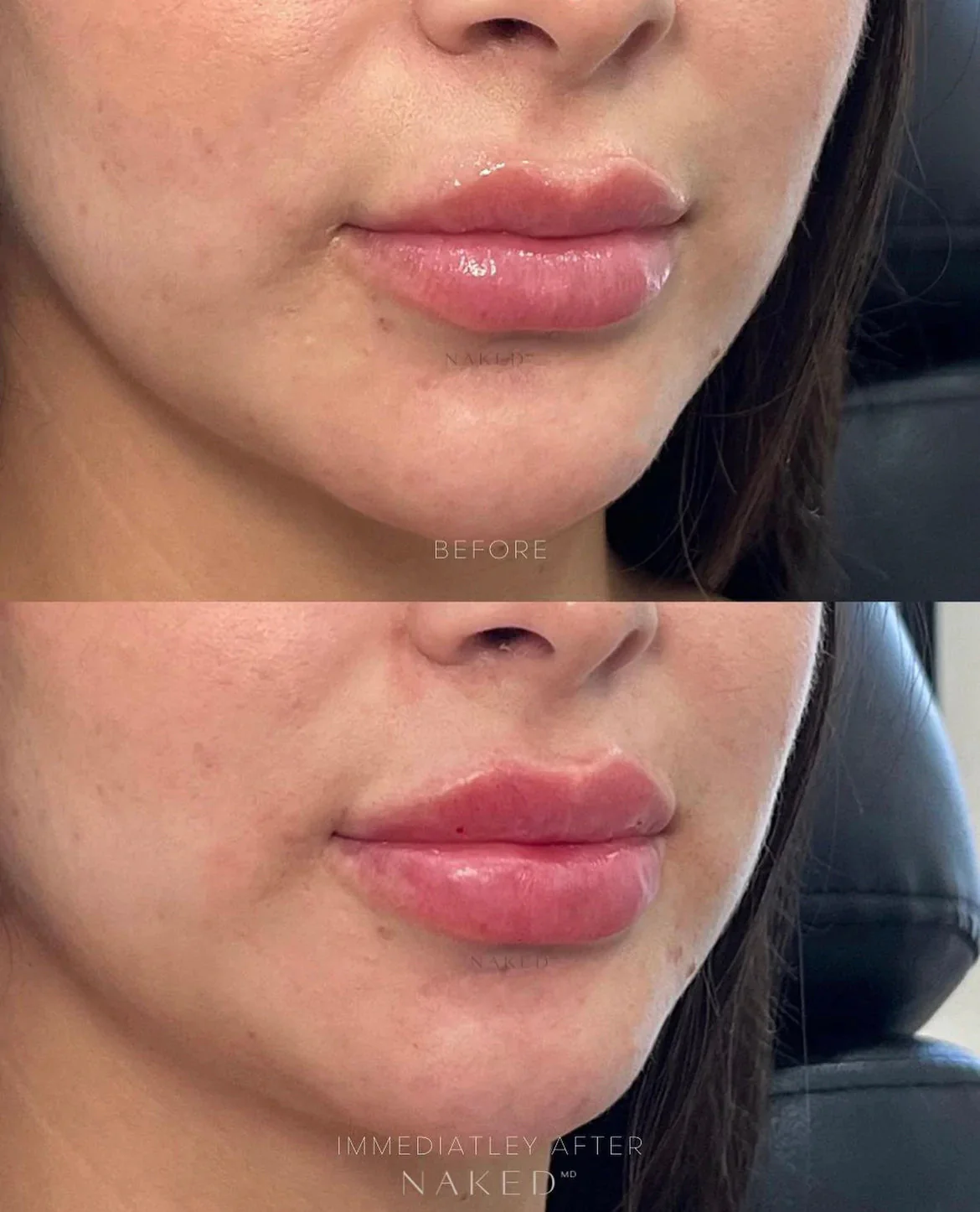 Lip Filler | New Client Offer - Image 71