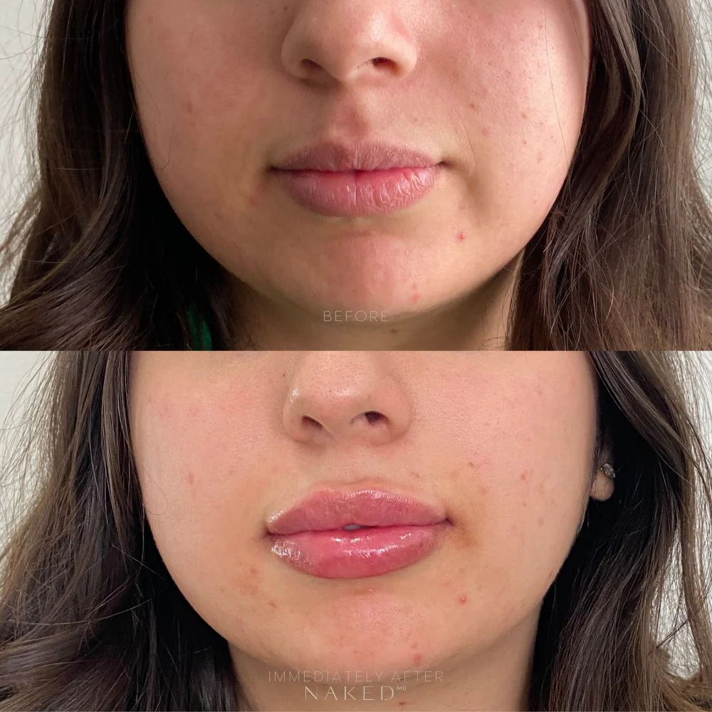 Lip Filler | New Client Offer - Image 9