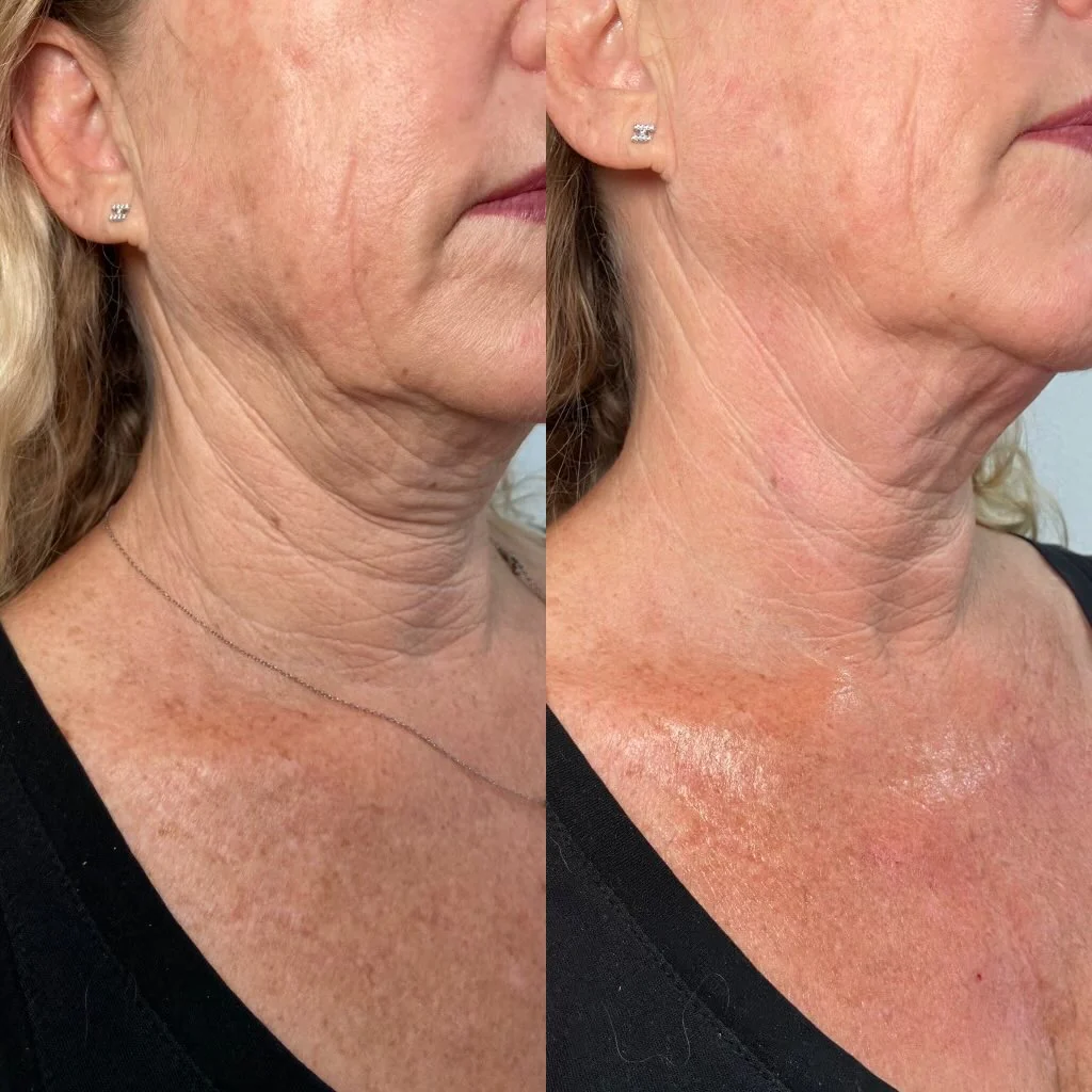 HyperDiluted Neck Filler | Radiesse - Image 4