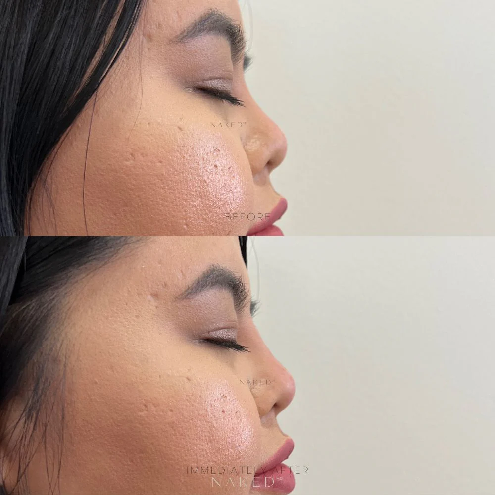 Naked Nose | Non-Surgical Nose Job (NSNJ) - Image 12