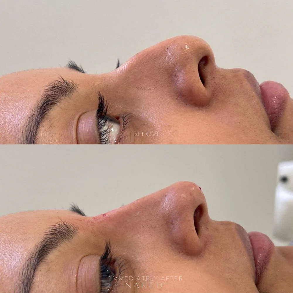 Naked Nose | Non-Surgical Nose Job (NSNJ) - Image 5