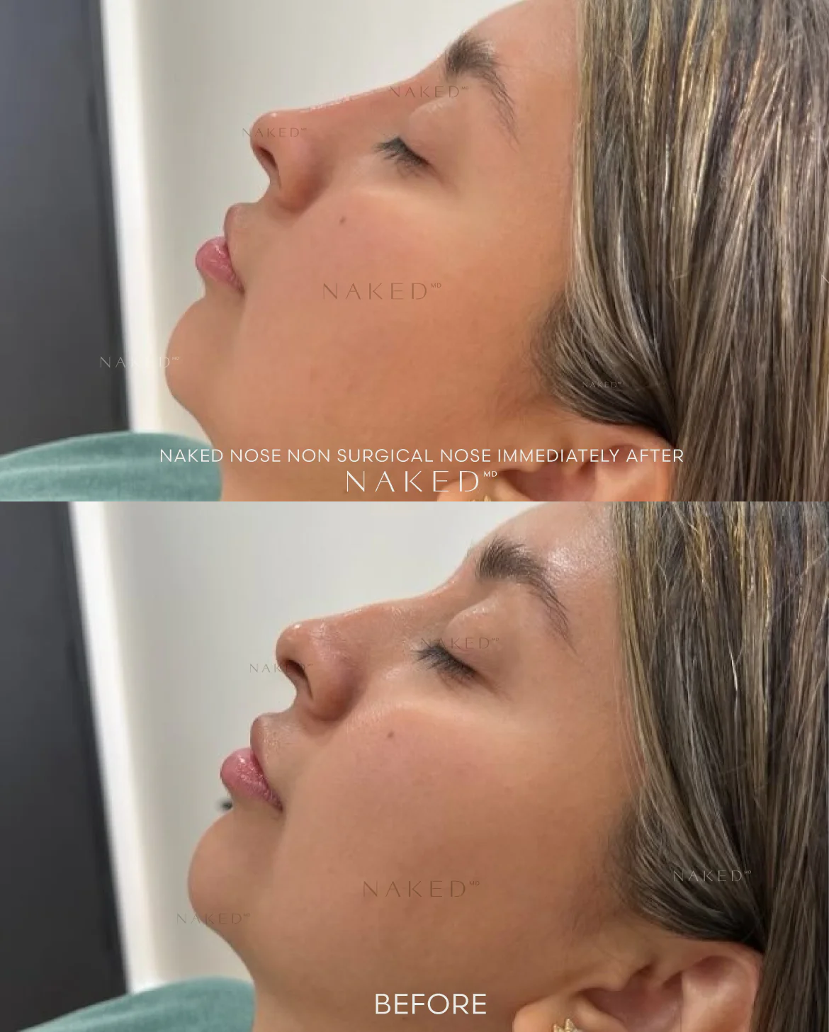 Naked Nose | Non-Surgical Nose Job (NSNJ) - Image 7