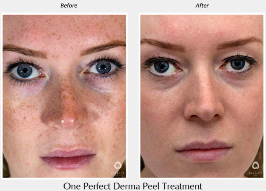 Perfect Derma Peel® - Image 10