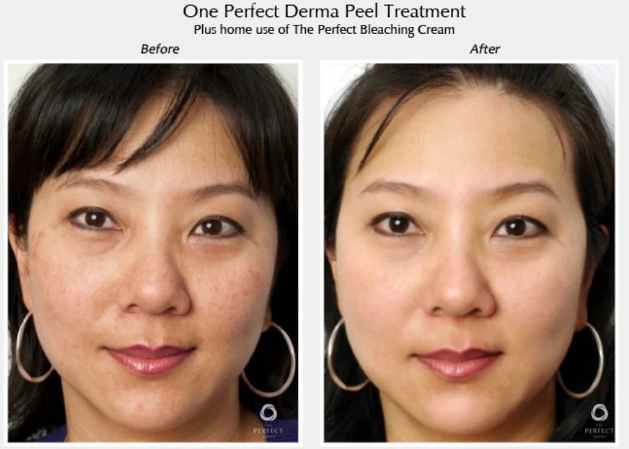 Perfect Derma Peel® - Image 11