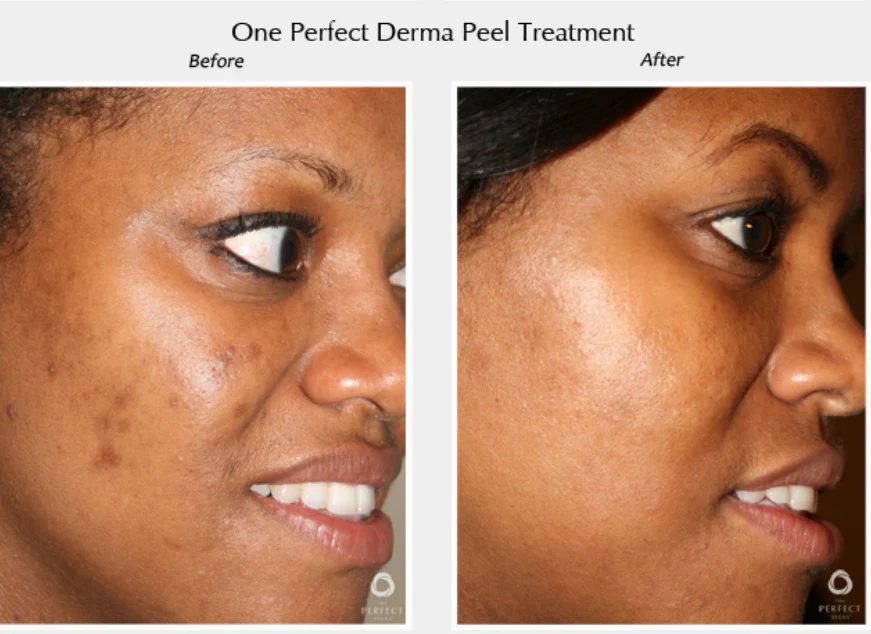 Perfect Derma Peel® - Image 12