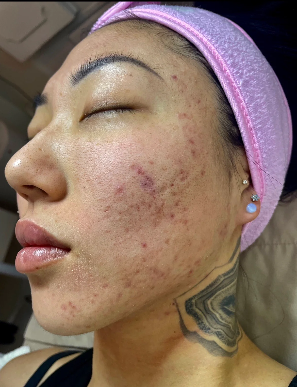 Perfect Derma Peel® - Image 3