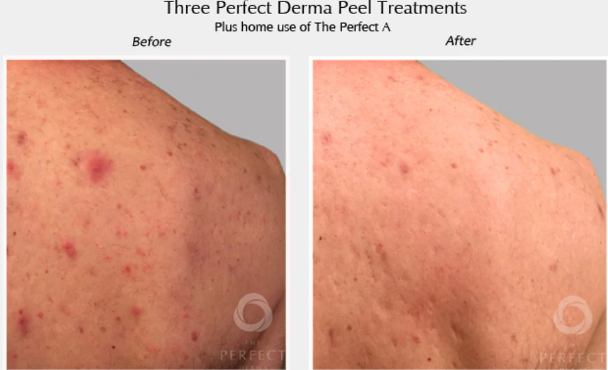 Perfect Derma Peel® - Image 5