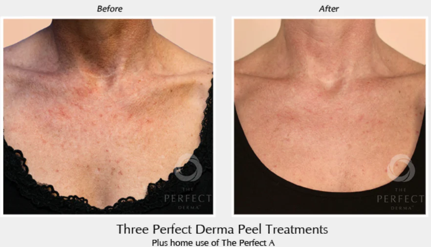 Perfect Derma Peel® - Image 6