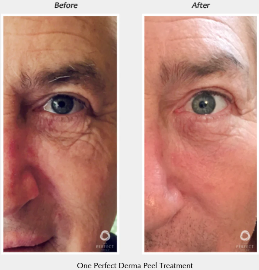 Perfect Derma Peel® - Image 7