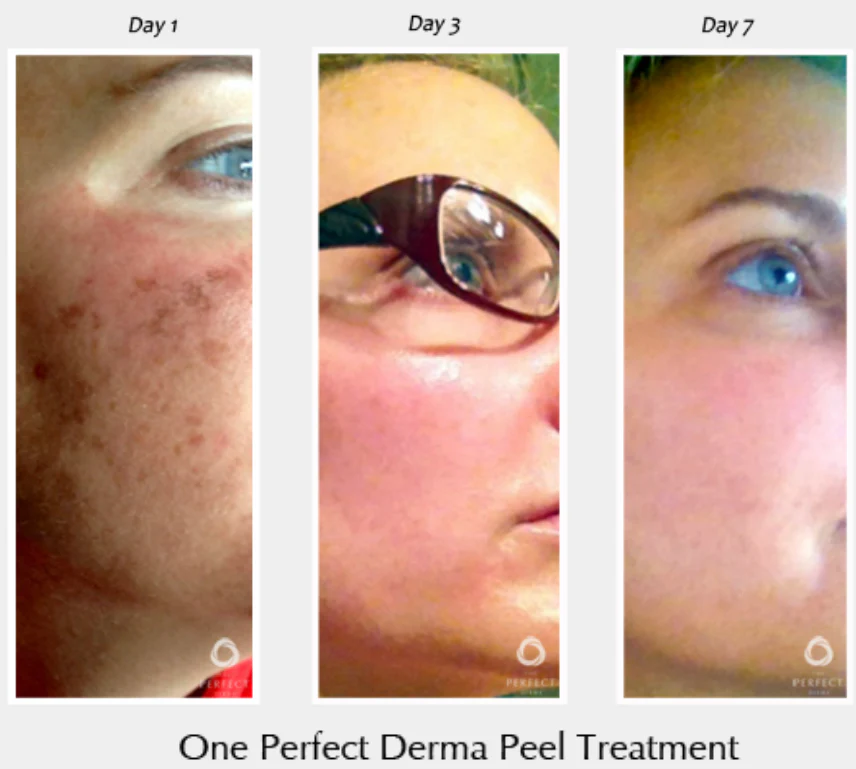 Perfect Derma Peel® - Image 8