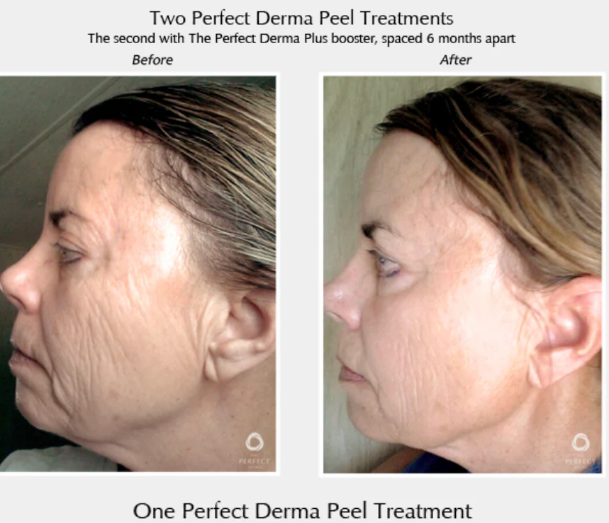 Perfect Derma Peel® - Image 9