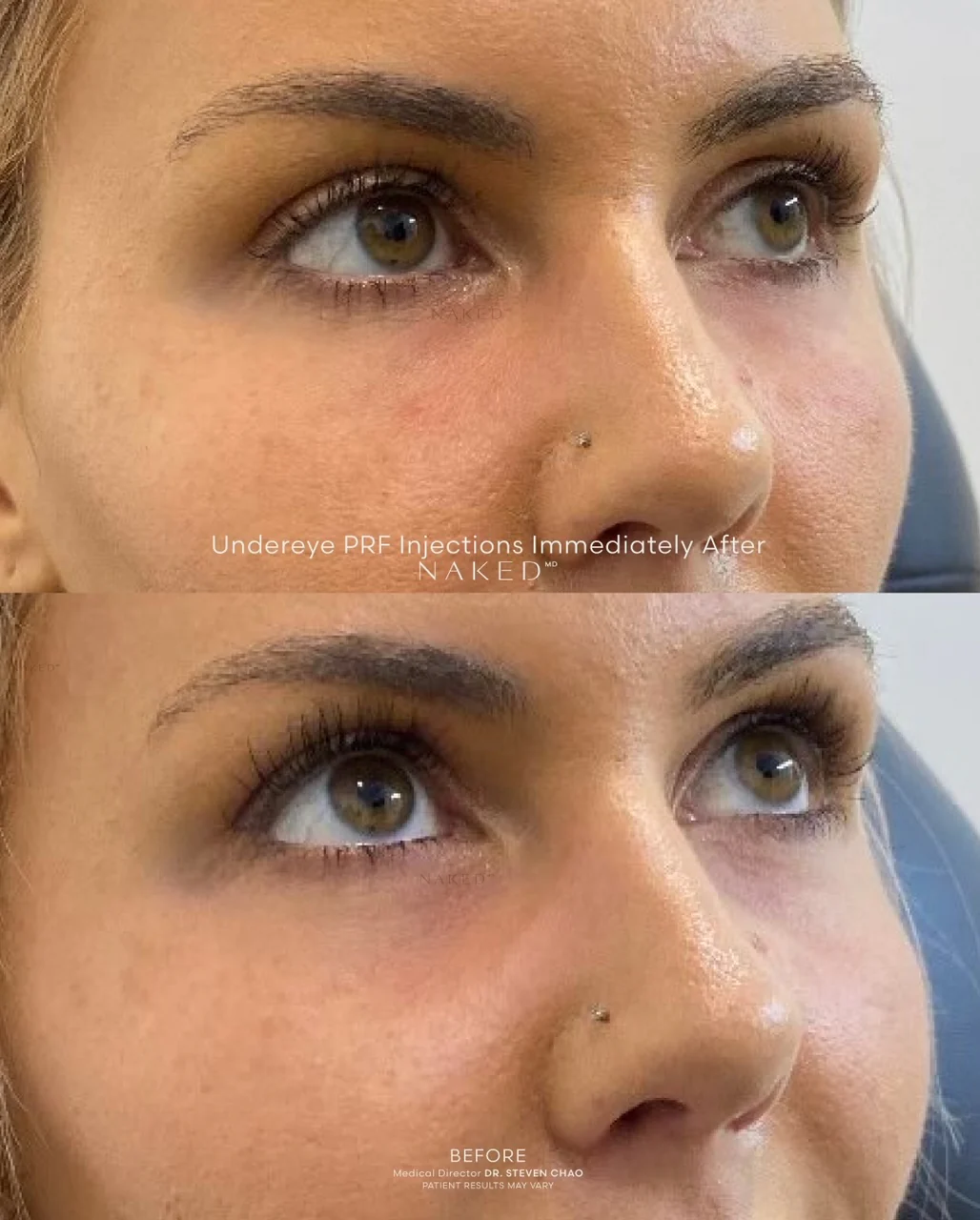 PRF (Platelet Rich Fibrin) Injection - Image 4