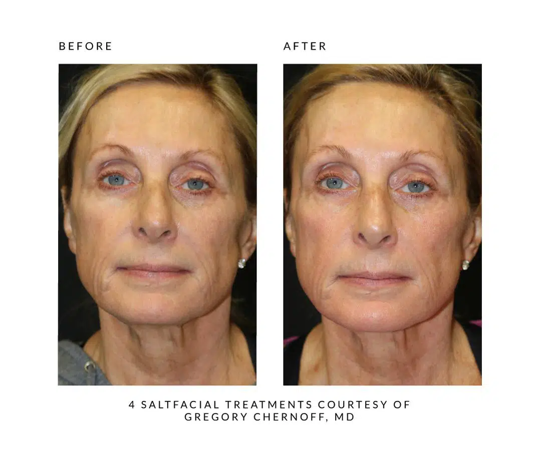 The SaltFacial® - Image 10
