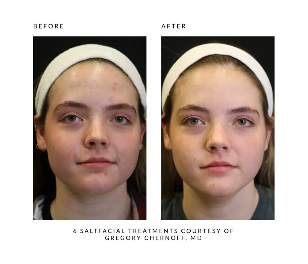The SaltFacial® - Image 11