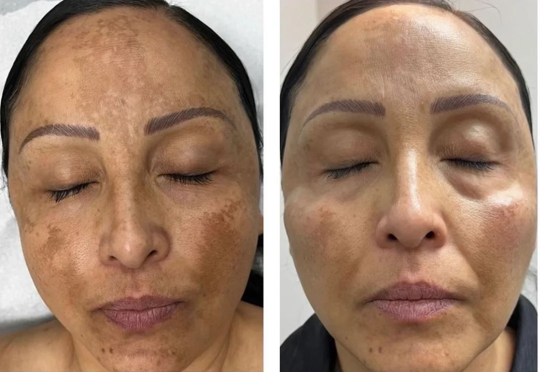 The SaltFacial® - Image 6