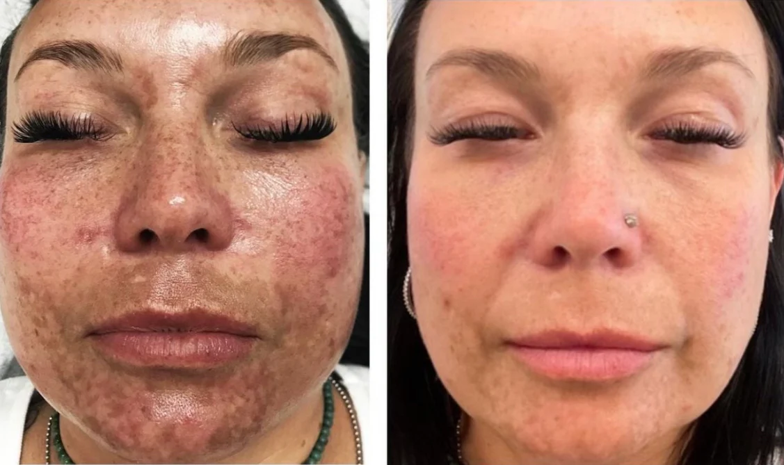 The SaltFacial® - Image 7