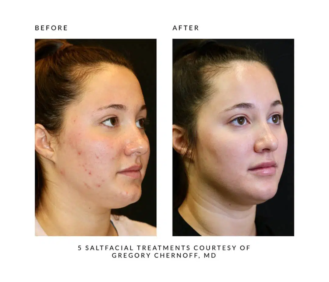 The SaltFacial® - Image 8
