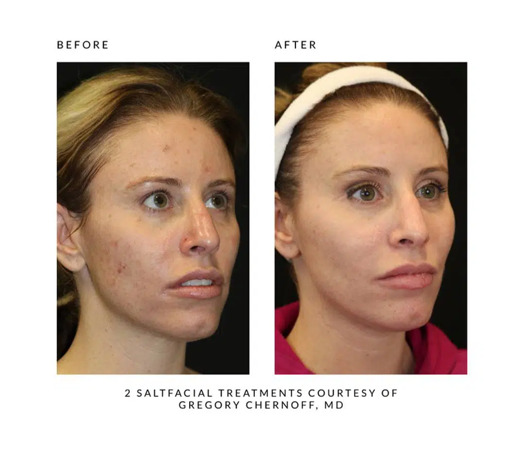 The SaltFacial® - Image 9