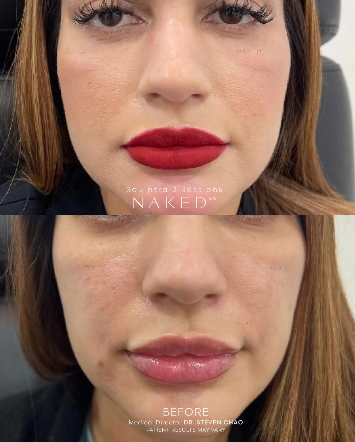 Sculptra® Filler - Image 10