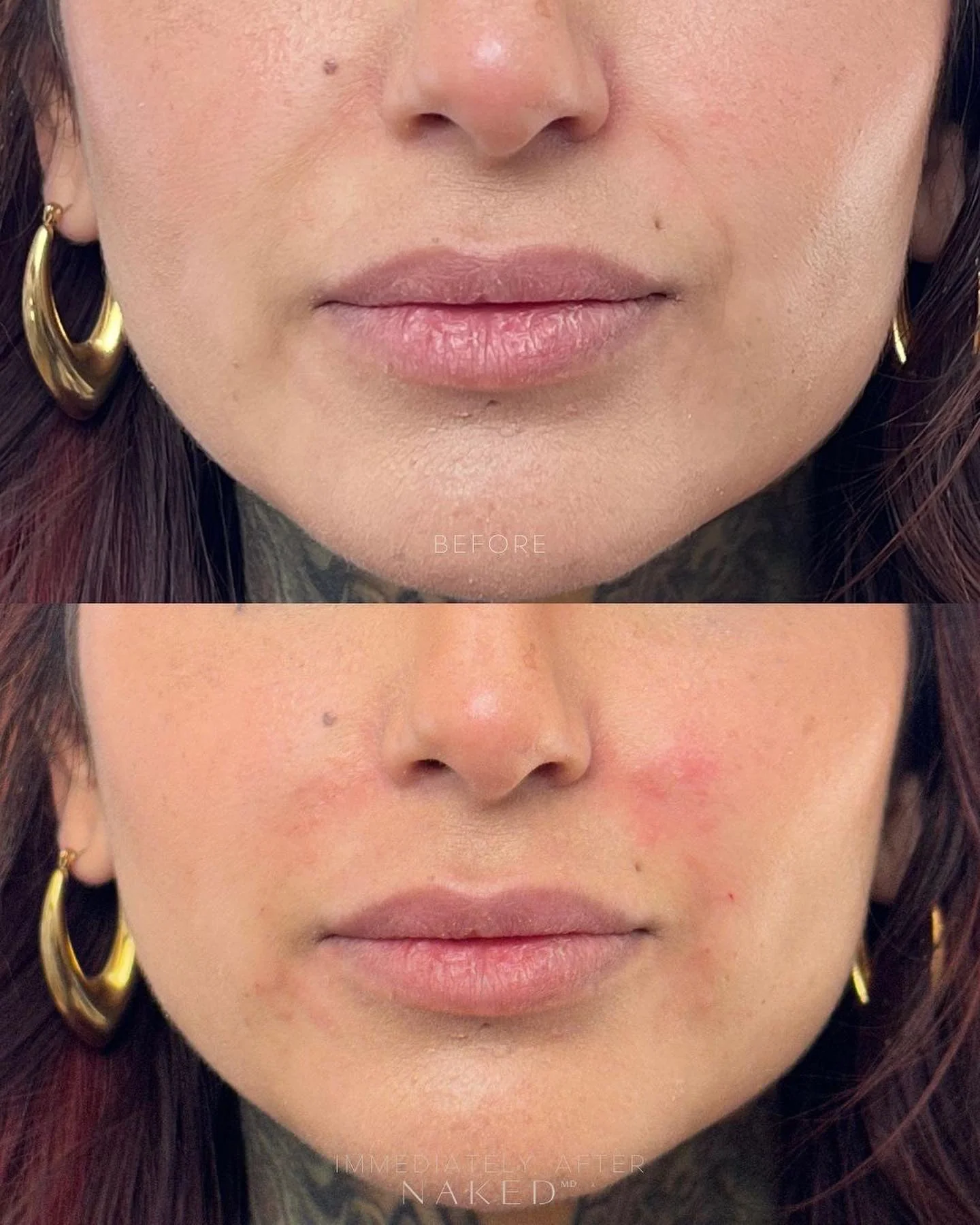 Smile Lines Filler | New Client Offer - Image 3