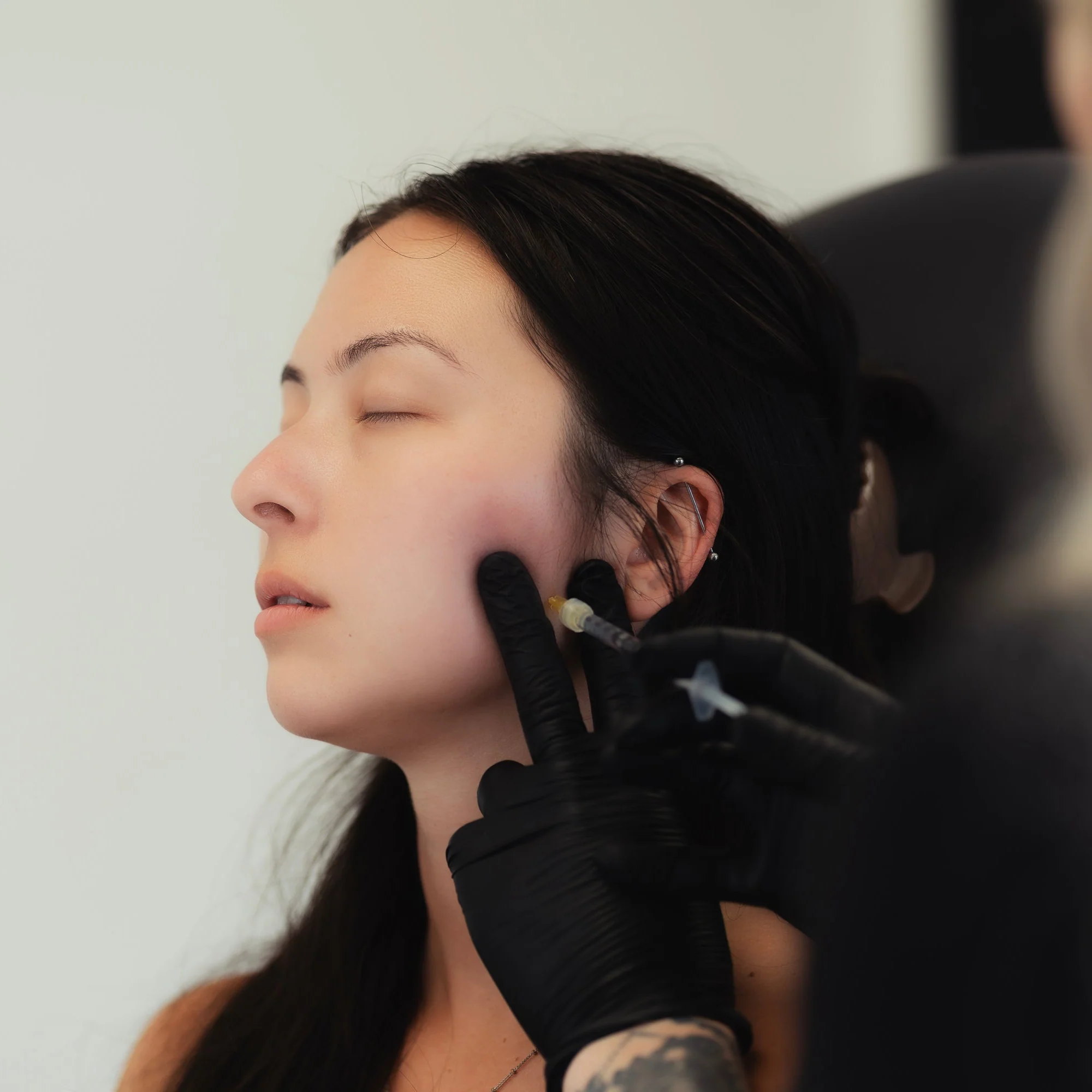 TOX | Slim Chin (Masseter) - Image 2