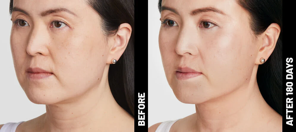 Ultherapy® | Non-Surgical Ultrasound Therapy - Image 16