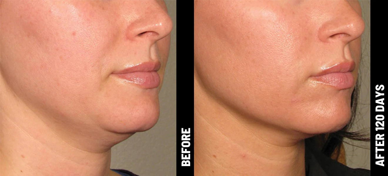 Ultherapy® | Non-Surgical Ultrasound Therapy - Image 17