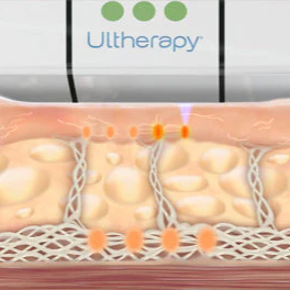 Ultherapy® | Non-Surgical Ultrasound Therapy - Image 3