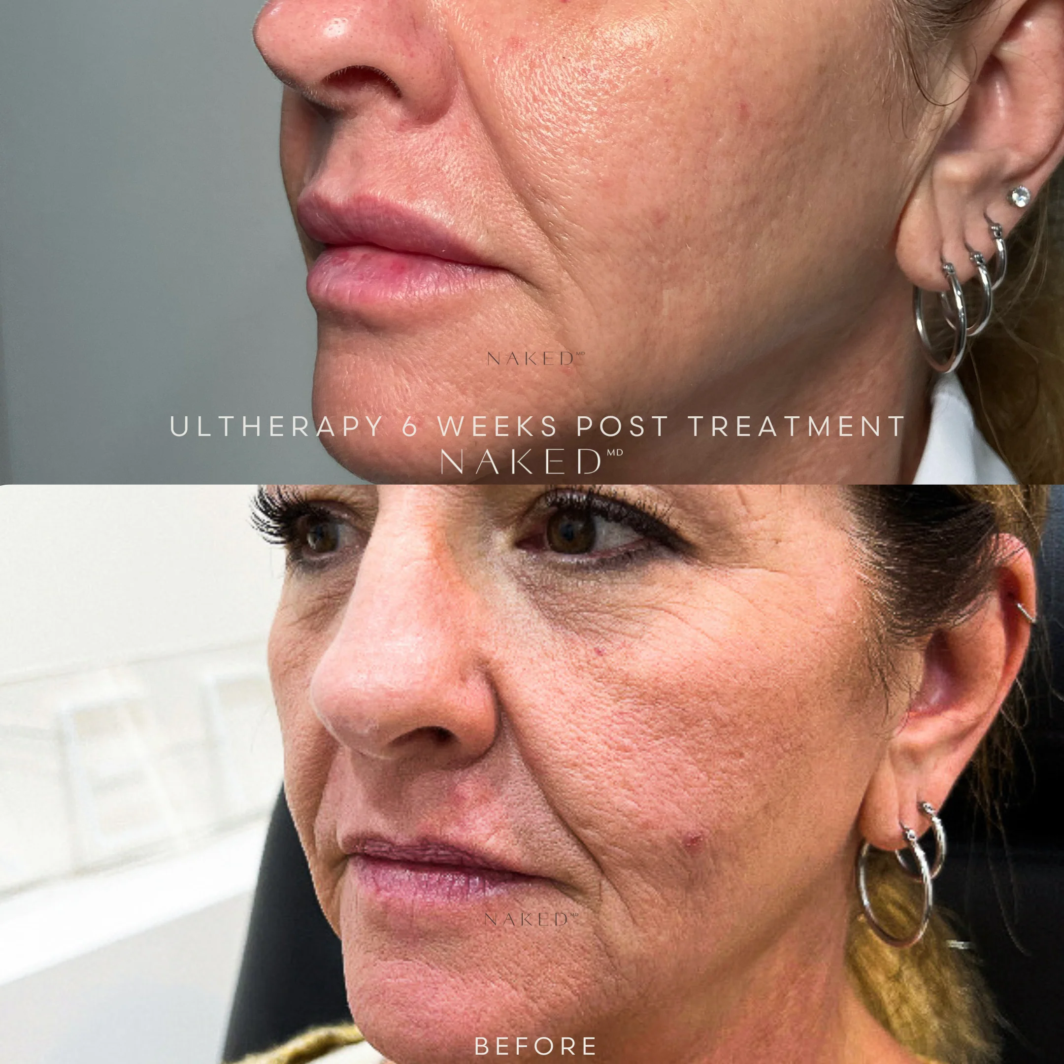 Ultherapy® | Non-Surgical Ultrasound Therapy - Image 5