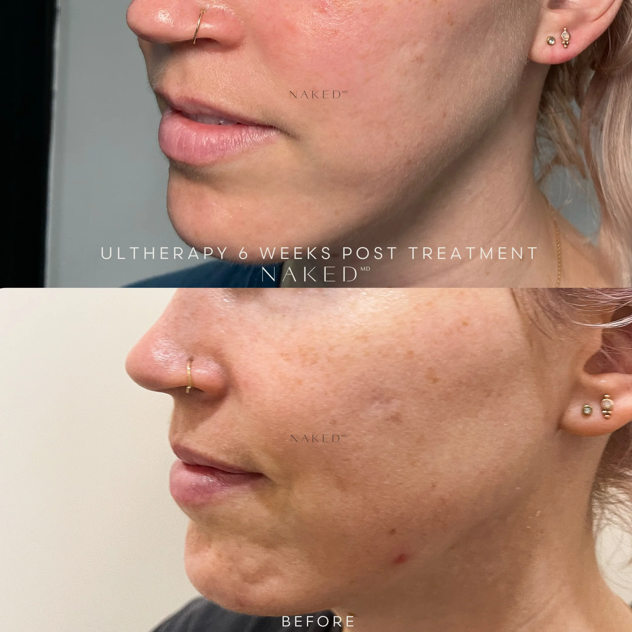 Ultherapy® | Non-Surgical Ultrasound Therapy - Image 9