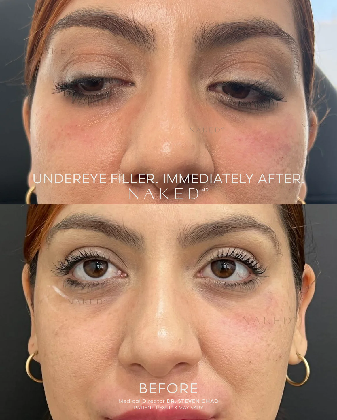 Undereye Filler - Image 7