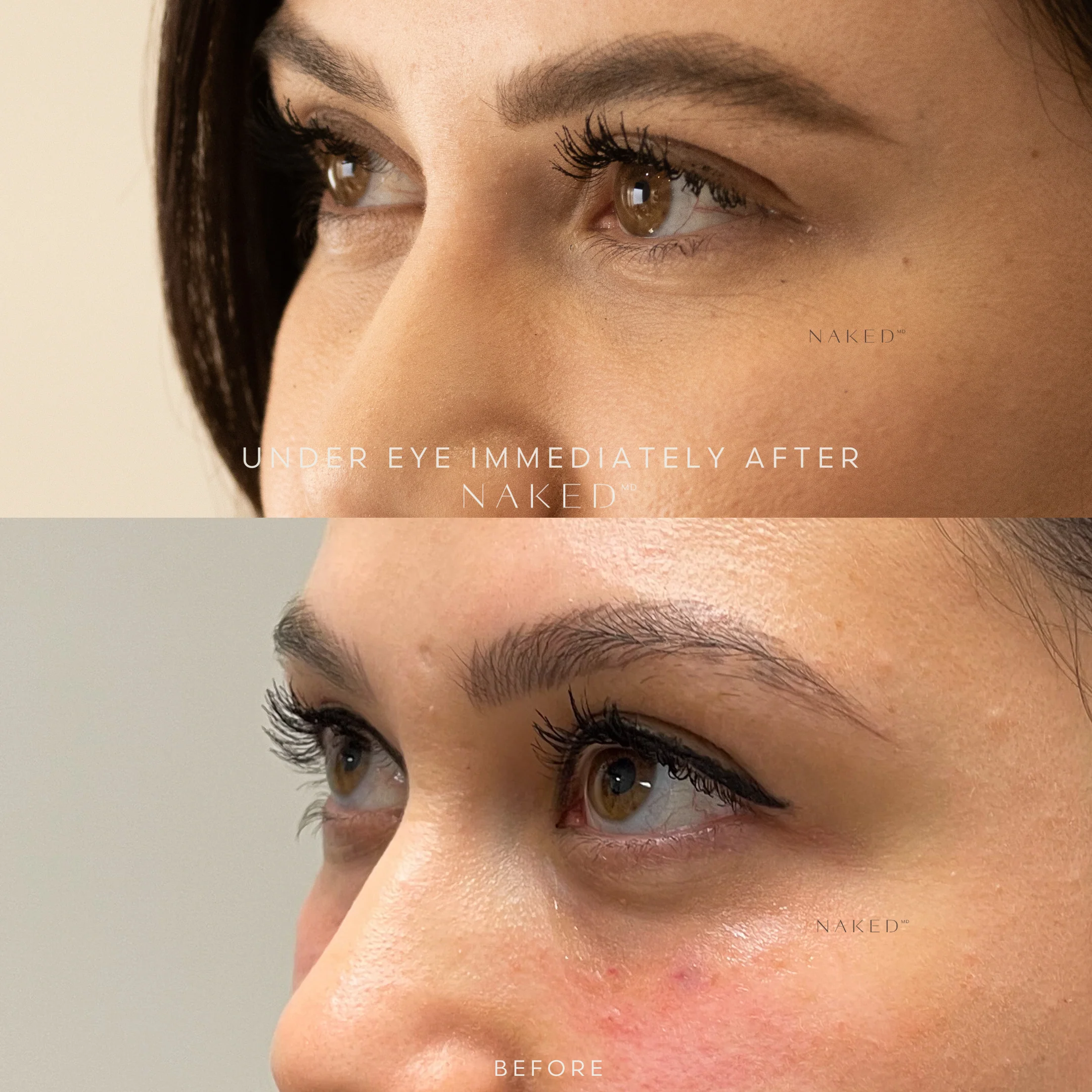 Undereye Filler - Image 8